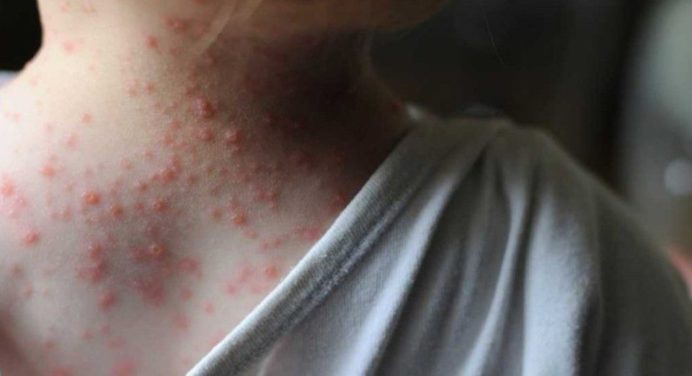 OMS: La transmisión de viruela del mono “se puede contener” en países no endémicos