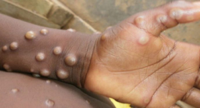 Viruela del mono: Conozca qué es, cómo se contagia y sus síntomas