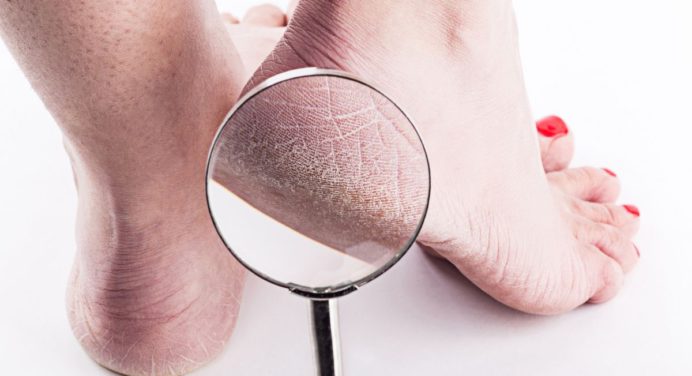 ¡No más talones agrietados! Elimínalos con esta vitamina