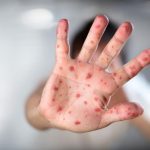 eeuu anuncio 18 millones de vacunas contra la viruela del mono laverdaddemonagas.com oevf4ns3bzdlxomss55wd2a7di