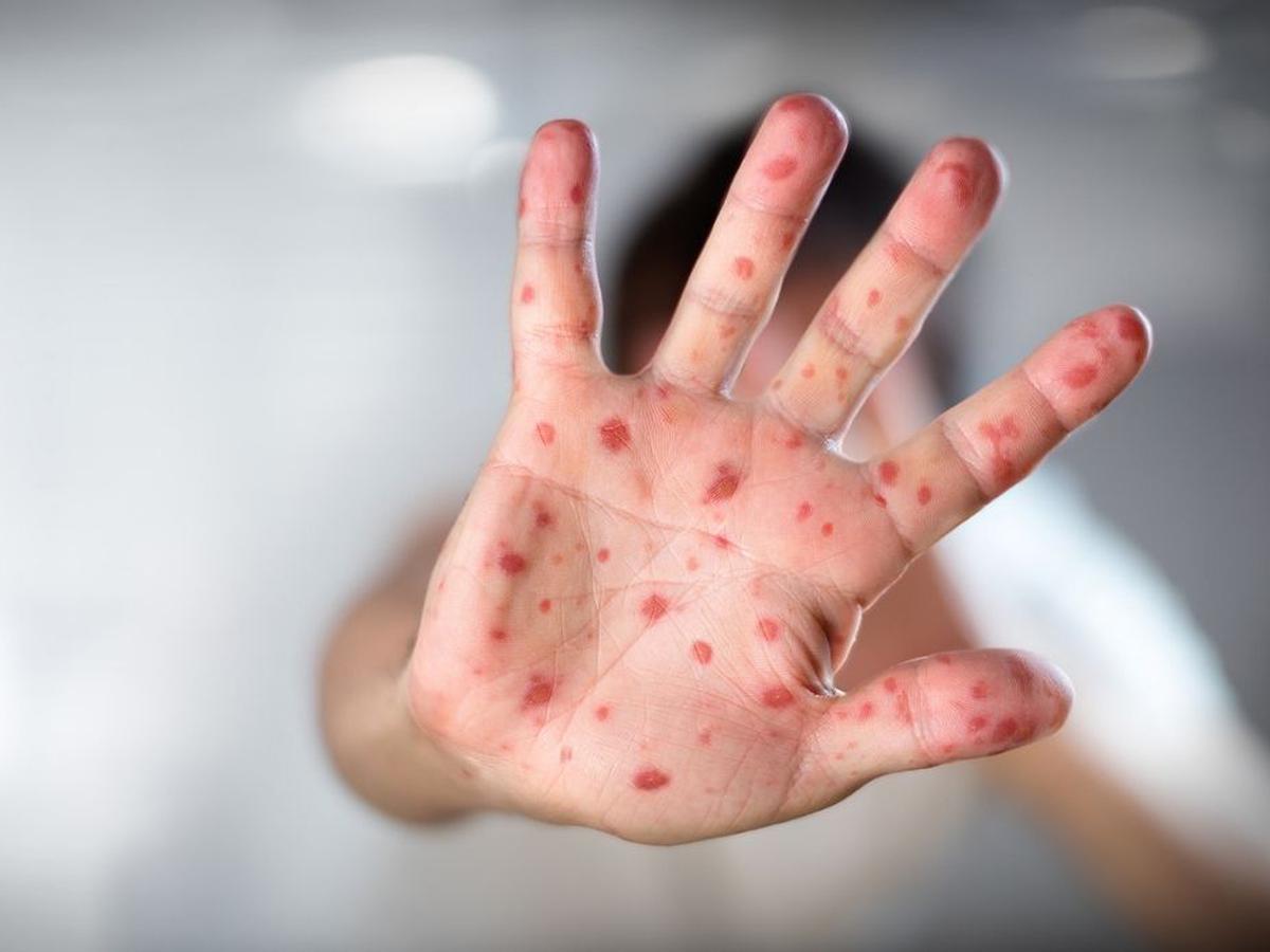 eeuu anuncio 18 millones de vacunas contra la viruela del mono laverdaddemonagas.com
