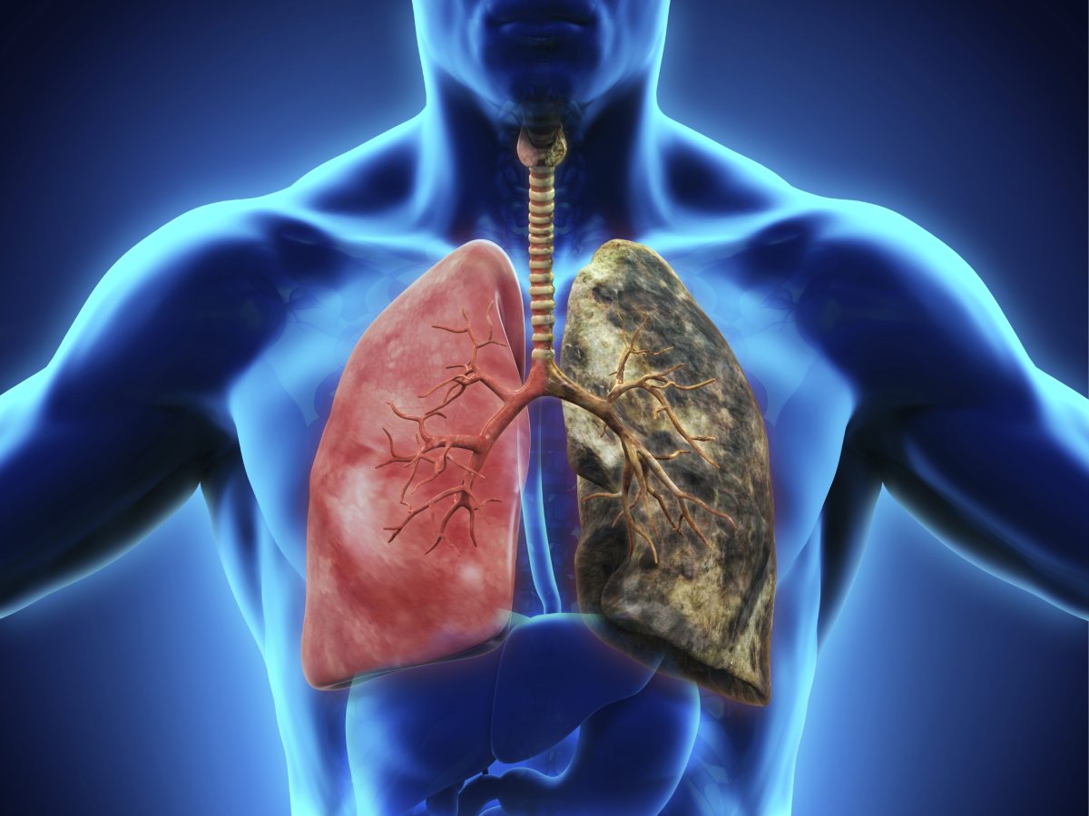 tabaquismo causa 20 de defunciones por cardiopatia coronaria laverdaddemonagas.com lung cancer nonsmokers 000044502606 large
