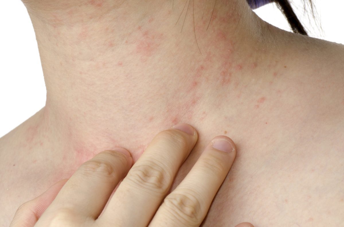 que son las alergias y cuales son las mas frecuentes laverdaddemonagas.com alergias 2