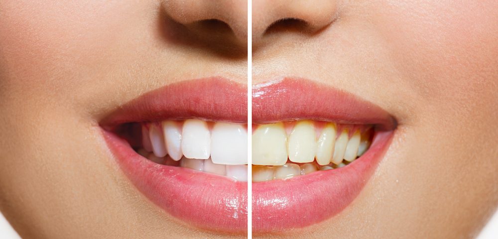 dientes amarillos conoce los tips para blanquearlos rapido y en casa laverdaddemonagas.com tener dientes blancos 1000x480 1