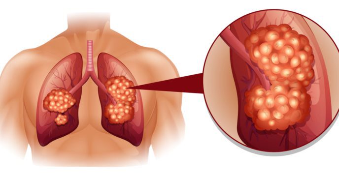 6 senales que pueden indicar cancer de pulmon laverdaddemonagas.com cancer de pulmon