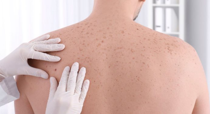 Exponerse en exceso a los rayos UV del sol es la principal causa del cáncer de piel