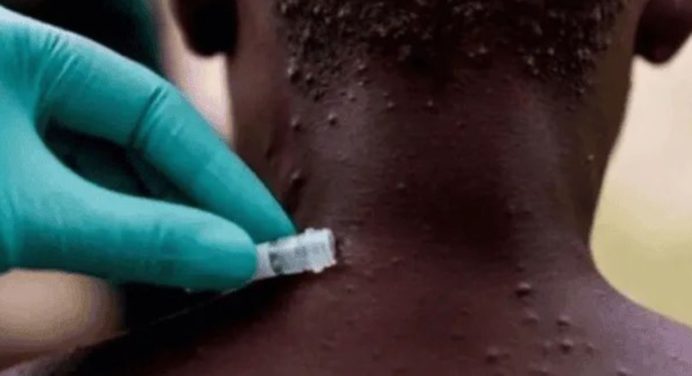 Kenia confirma su segundo caso de Mpox