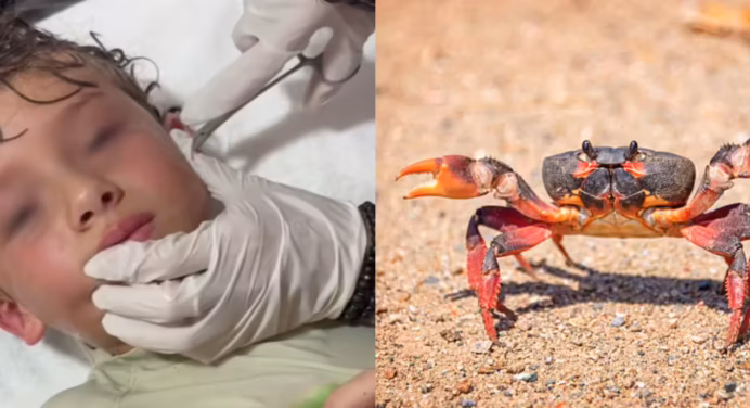 Le extraen cangrejo del oído a niño tras pasar un día en la playa (+video)