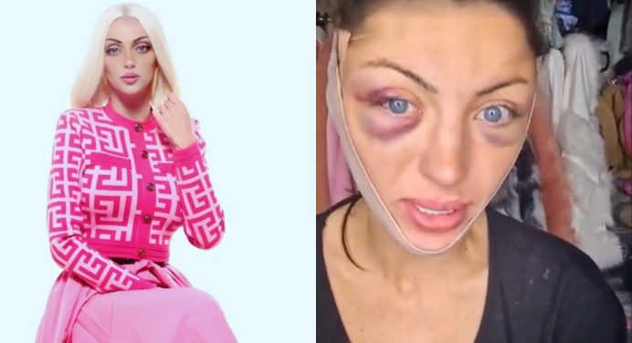 Murió la Barbie humana tras realizarse 27 operaciones