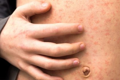 contagio de sarampión