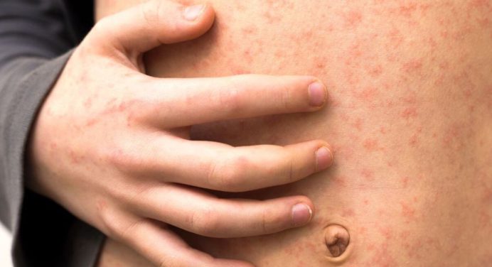 Se activa el contagio de sarampión en España según la OMS